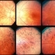 Retinitis Pigmentosa